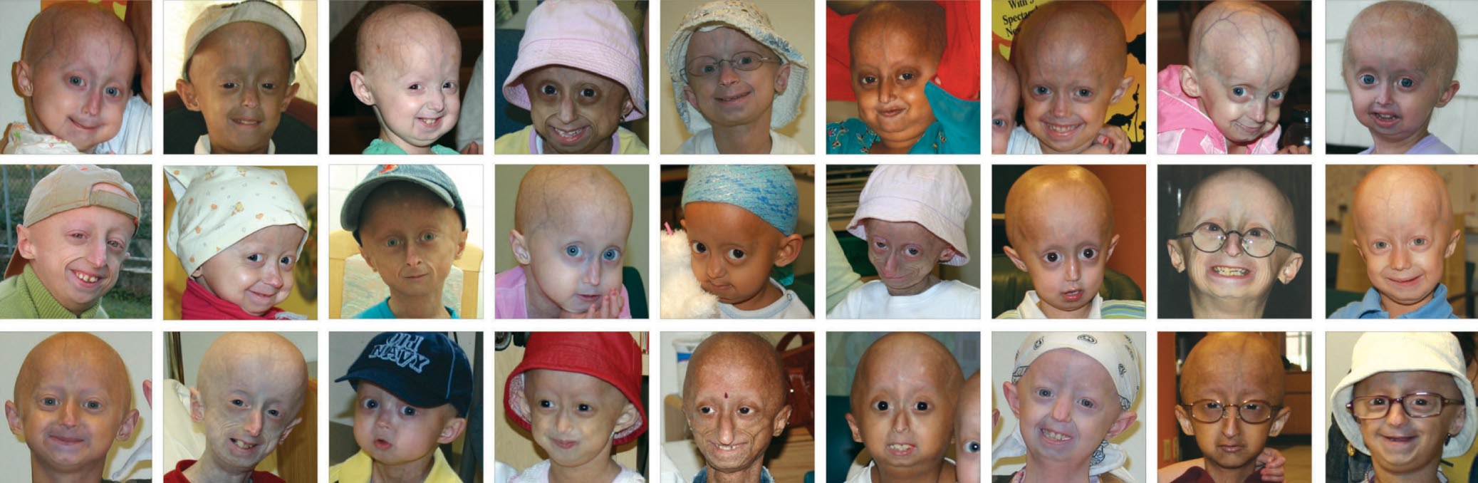 Pictures of 27 children with Progeria