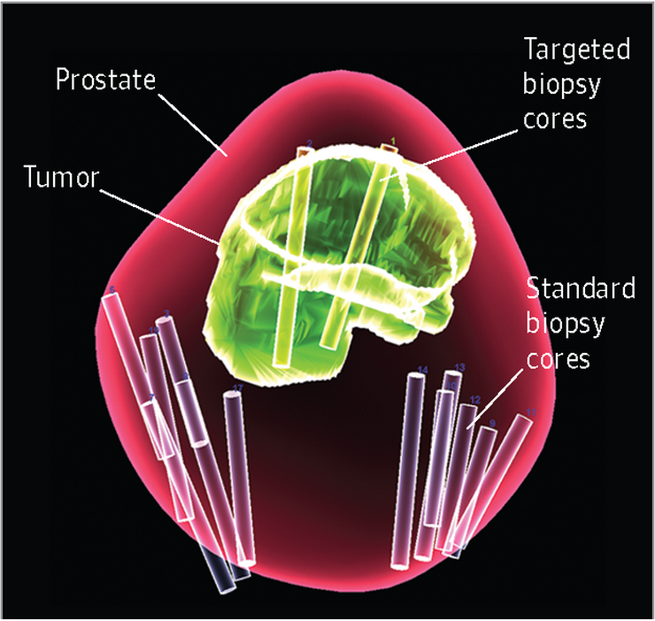 3D data map of prostate biopsies