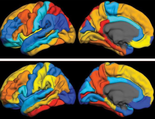 PET imaging of brains affected by Alzheimer's disease
