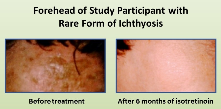 Forehead of study participant with rare form of ichthyosis