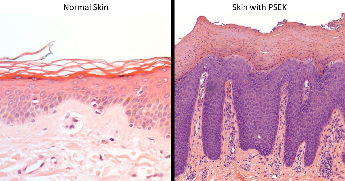 Histology of normal skin compared to skin with PSEK