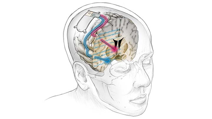 Transparent man's head showing an implanted unit and electrodes running deep into the brain