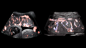 Ultrasound image of placenta