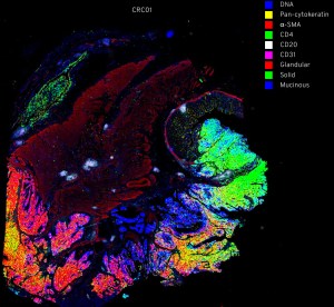 Brightly colored light microscopy showing locations for DNA, Pan-cytokeratin, alpha-SMA, CD4, CD20, CD31, Glandular, Solid, Mucinous