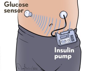 Abdomen of a young child. A glucose sensor, attached to the skin sends a signal to an insulin pump which is hanging from the child's pants. A tube runs to a another adhesive on the abdomen to deliver insulin.