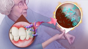 An elderly woman holds her wrist. An inset shows gum disease in her mouth. Bacteria and antibodies from the gums move to the joints where the antibodies stick to the surface of the joints.